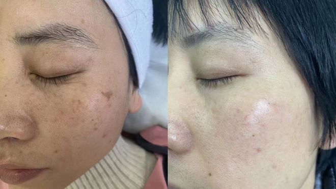 半岛·综合体育入口远离百“斑”刁难南溪山医院祛斑美肤再添利器(图2)